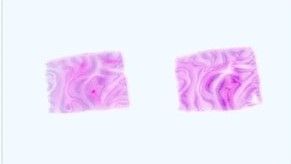 Paraffin Tissue Section - Human Abdominal Tumor: Malignant Mesothelioma